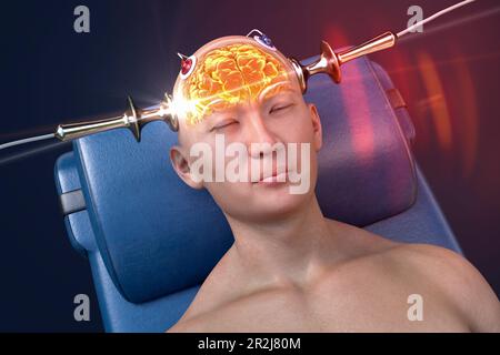 Electroconvulsive therapy, illustration Stock Photo