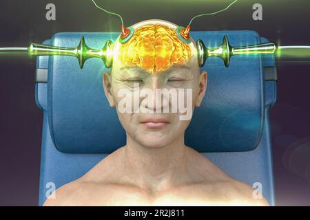 Electroconvulsive therapy, illustration Stock Photo