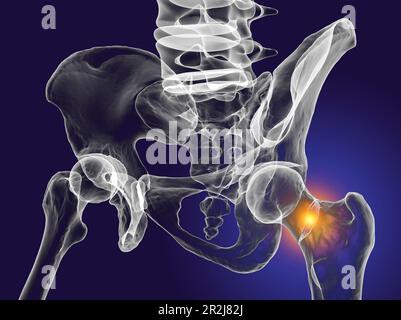 Fracture of the femur neck, illustration Stock Photo