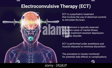 Electroconvulsive therapy, illustration Stock Photo