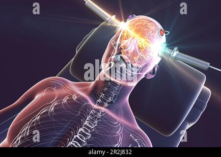 Electroconvulsive therapy, illustration Stock Photo