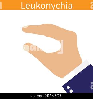 vector illustration of hand with leukonychia a  medical condition Stock Vector