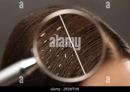 Collage showing woman's hair before and after lice treatment on grey background, closeup. View on parasitic insect through magnifying glass. Suffering Stock Photo