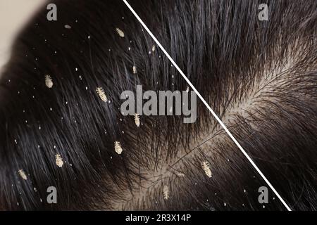 Collage showing woman's hair before and after lice treatment, closeup. Suffering from pediculosis Stock Photo
