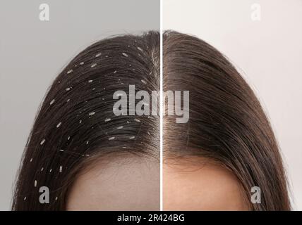 Collage showing woman's hair before and after lice treatment on light background, closeup. Suffering from pediculosis Stock Photo
