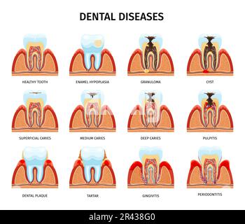 Teeth anatomy problems set with isolated compositions of tooth in jaw healthy and damaged with text vector illustration Stock Vector