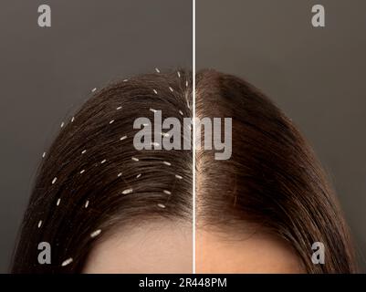 Collage showing woman's hair before and after lice treatment on grey background, closeup. Suffering from pediculosis Stock Photo