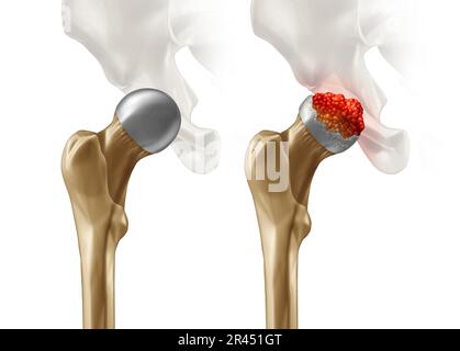 OSTEONECROSIS OF THE HIP Stock Photo - Alamy