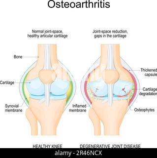 Osteoarthritis. Healthy knee join, and arthritis. degenerative joint disease. Vector illustration Stock Vector