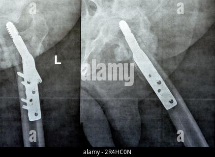 Left hip trans cervical neck of femur fracture fixated by DHS Dynamic Hip Screw, Plain x ray PXR of an old patient, a femoral head-sparing orthopaedic Stock Photo