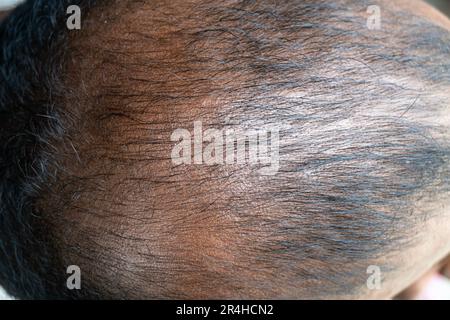 Bald head of an adult man from the back. Alopecia on the head. Bald head of a black asian man. Hair loss in men Stock Photo
