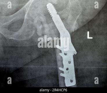 Left hip trans cervical neck of femur fracture fixated by DHS Dynamic Hip Screw, Plain x ray PXR of an old patient, a femoral head-sparing orthopaedic Stock Photo