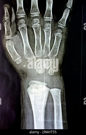 A PXR plain x ray of right wrist joint of skeletally immature female child patient shows neglected physeal injury of right distal radius bone, Injury Stock Photo