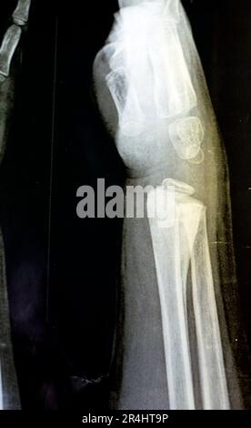 A PXR plain x ray of right wrist joint of skeletally immature female child patient shows neglected physeal injury of right distal radius bone, Injury Stock Photo