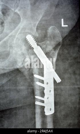 Left hip trans cervical neck of femur fracture fixated by DHS Dynamic Hip Screw, Plain x ray PXR of an old patient, a femoral head-sparing orthopaedic Stock Photo