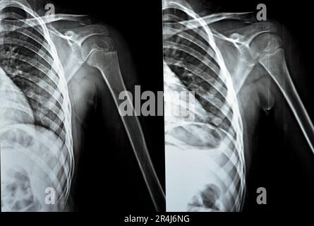 Plain x Ray PXR of left shoulder of skeletally immature female patient child showing lateral one third fracture clavicle, broken lateral part of the c Stock Photo