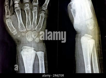 A PXR plain x ray of right wrist joint of skeletally immature female child patient shows neglected physeal injury of right distal radius bone, Injury Stock Photo