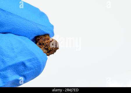 Nephrolithiasis, irregular brown kidney stones (renal calculus or nephrolith), the stones are different in size after operative ureteroscopy and Laser Stock Photo