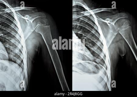 Plain x Ray PXR of left shoulder of skeletally immature female patient child showing lateral one third fracture clavicle, broken lateral part of the c Stock Photo