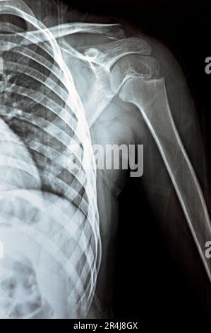 Plain x Ray PXR of left shoulder of skeletally immature female patient child showing lateral one third fracture clavicle, broken lateral part of the c Stock Photo