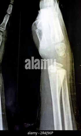 A PXR plain x ray of right wrist joint of skeletally immature female child patient shows neglected physeal injury of right distal radius bone, Injury Stock Photo