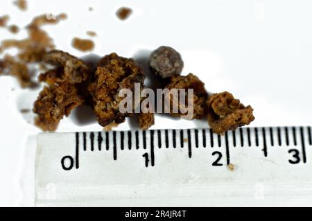 Nephrolithiasis, irregular brown kidney stones (renal calculus or nephrolith), the stones are different in size after operative ureteroscopy and Laser Stock Photo