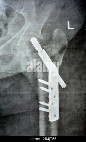 Left hip trans cervical neck of femur fracture fixated by DHS Dynamic Hip Screw, Plain x ray PXR of an old patient, a femoral head-sparing orthopaedic Stock Photo