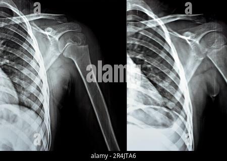 Plain x Ray PXR of left shoulder of skeletally immature female patient child showing lateral one third fracture clavicle, broken lateral part of the c Stock Photo