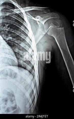 Plain x Ray PXR of left shoulder of skeletally immature female patient child showing lateral one third fracture clavicle, broken lateral part of the c Stock Photo