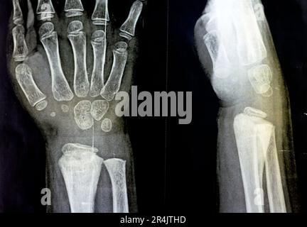 A PXR plain x ray of right wrist joint of skeletally immature female child patient shows neglected physeal injury of right distal radius bone, Injury Stock Photo