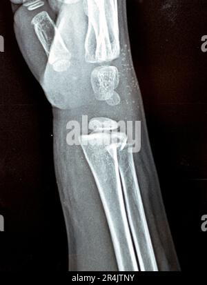 A PXR plain x ray of right wrist joint of skeletally immature female child patient shows neglected physeal injury of right distal radius bone, Injury Stock Photo