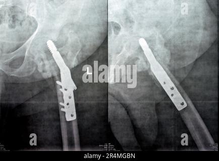 Left hip trans cervical neck of femur fracture fixated by DHS Dynamic Hip Screw, Plain x ray PXR of an old patient, a femoral head-sparing orthopaedic Stock Photo