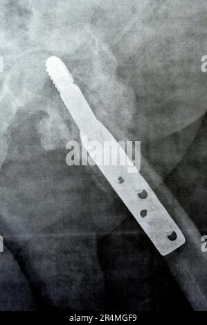 Left hip trans cervical neck of femur fracture fixated by DHS Dynamic Hip Screw, Plain x ray PXR of an old patient, a femoral head-sparing orthopaedic Stock Photo