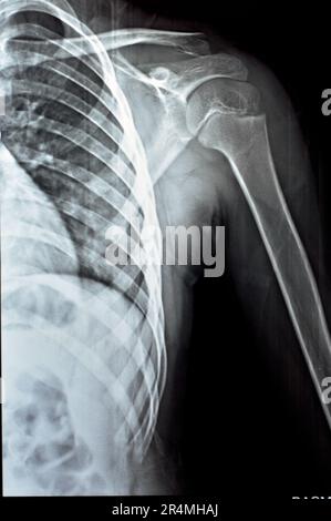 Plain x Ray PXR of left shoulder of skeletally immature female patient child showing lateral one third fracture clavicle, broken lateral part of the c Stock Photo