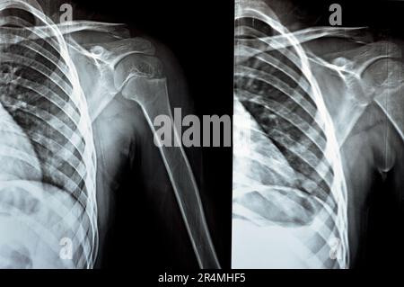 Plain x Ray PXR of left shoulder of skeletally immature female patient child showing lateral one third fracture clavicle, broken lateral part of the c Stock Photo