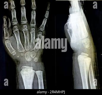 A PXR plain x ray of right wrist joint of skeletally immature female child patient shows neglected physeal injury of right distal radius bone, Injury Stock Photo