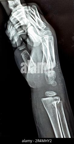 A PXR plain x ray of right wrist joint of skeletally immature female child patient shows neglected physeal injury of right distal radius bone, Injury Stock Photo