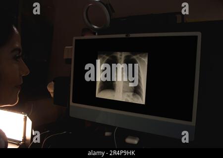 Pulmonologist woman checks on the computer Xray of patient  post anterior chest X-ray showing lung parenchyma homogeneous radiographic pattern and aor Stock Photo