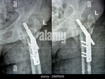 Left hip trans cervical neck of femur fracture fixated by DHS Dynamic Hip Screw, Plain x ray PXR of an old patient, a femoral head-sparing orthopaedic Stock Photo