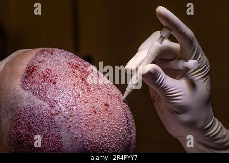 Hair transplant dhi and fue system. Hair Transplant patient after the operation. Surgeons in the operating room carry out hair transplant surgery. Stock Photo