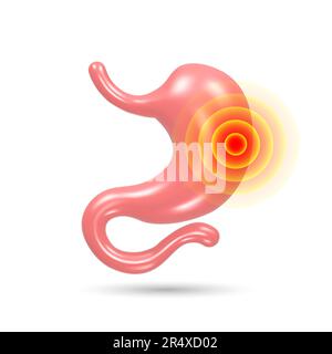 Stomach pain and heartburn. Digestive disease. Gastritis and acid reflux. 3D vector illustration. Stock Vector