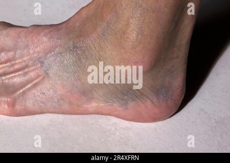 Closeup of a woman's sprained ankle that's highly discolored. Model Released. Stock Photo