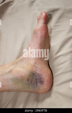 Closeup of a woman's sprained ankle that's highly discolored. Model Released. Stock Photo