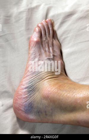 Closeup of a woman's sprained ankle that's highly discolored. Model Released. Stock Photo