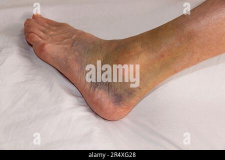 Closeup of a woman's sprained ankle that's highly discolored. Model Released. Stock Photo