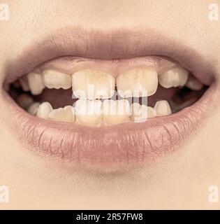 Bad teeth child. Portrait boy with bad teeth. Close up of unhealthy baby teeths. Kid patient open mouth showing cavities teeth decay Stock Photo