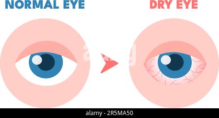 Dry eyes. Healthy unhealthy red eye, driing astonished redness irritated surface eyeball, conjunctivitis glaucoma disease or lens allergies, optometry concept vector illustration Stock Vector