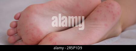 Eczema is an irritation caused by an allergic lesion of skin of feet in child Stock Photo