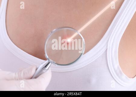 Laser mole removal. Doctor looking at patient's skin through magnifying glass during procedure, closeup Stock Photo