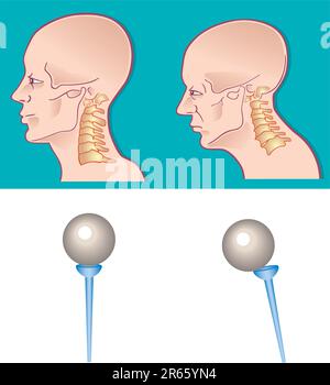 Illustration of neck spine cross section Stock Vector Image & Art - Alamy